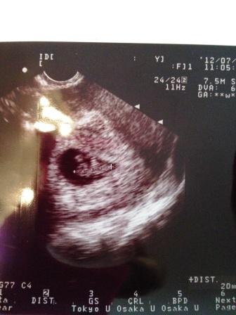 稽留流産ではなかった 8w5d 奇跡的 8週で初めて赤ちゃん確認 キャミーのbaby待ちブログ